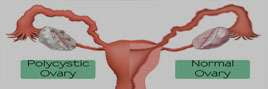 Polycystic Ovary Syndrome