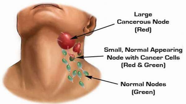 swollen lymph nodes