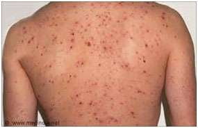 Skin Problems